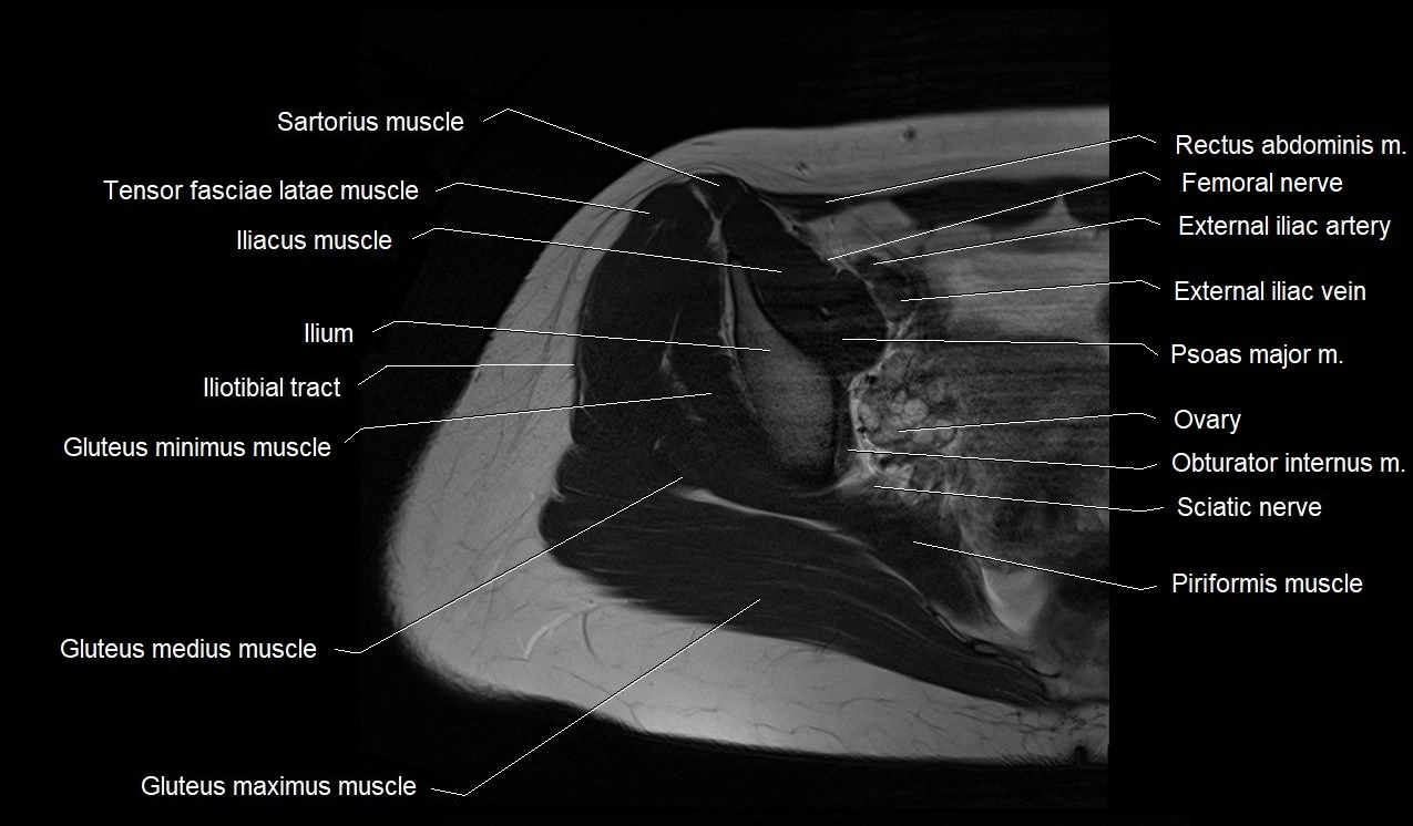 MRI thigh cross sectional anatomy image 2.webp